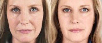 Cheek surgery