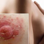 Почему шелушатся соски и опасно ли это? Отвечаем на актуальные вопросы