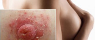 Why do nipples peel and is it dangerous? We answer pressing questions 