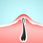 Why does hair grow ingrown after hair removal?