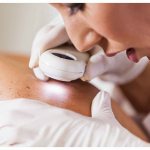 подготовка к удалению родинки