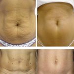 Skin tightening on the abdomen using mesotherapy