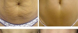 Skin tightening on the abdomen using mesotherapy
