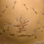 Tummy tuck with mesothreads