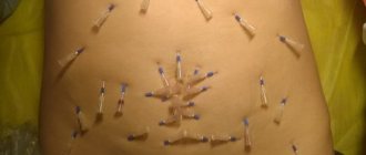 Tummy tuck with mesothreads