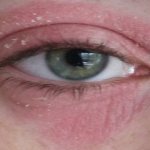 Redness and peeling of the upper and lower eyelids
