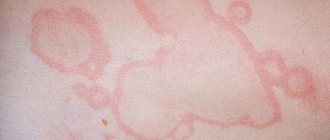 Покраснение в виде кольца на коже