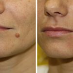 Последствия удаления папиллом лазером - отзывы