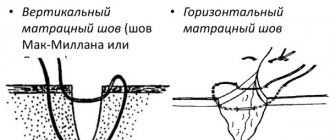 Послеоперационный шов не заживает: покраснение, уплотнение, нагноение, мокнет, чешется, болит. Лечение
