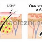 The appearance of acne on the skin