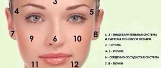 Cause-and-effect relationship between acne localization and diseases