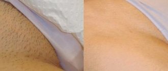 hair removal examples