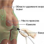 принцип липоскульптуры