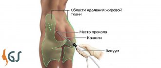 liposculpture principle