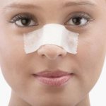 Swelling of the nose after rhinoplasty