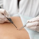 Electrocoagulation is performed