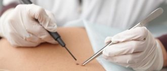 Electrocoagulation is performed