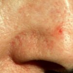 Пятно на носу: красное, пигментное, на кончике носа шелушится