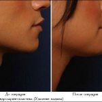 Результат операции по удалению кадыка для феминизации голоса