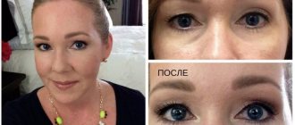 result of the procedure