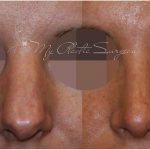 Rhinoplasty. Baga D.K. 