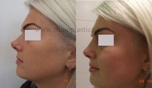 Ринопластика кончика носа фото до и после, задранный кончик носа