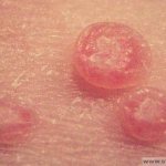 Розовые угри: чем лечить и какие причины появления? фото