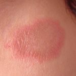 Pityriasis rosea