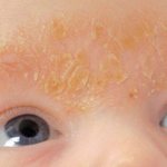 seborrheic dermatitis on the face in children