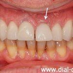 шатается передний зуб