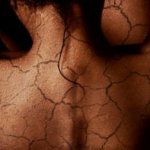 Flaky skin on the body