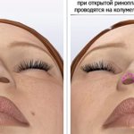 Methods for correcting keloid scars after rhinoplasty