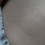 Dry spots on the skin - what are the reasons for their appearance?