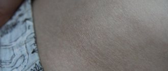 Dry spots on the skin - what are the reasons for their appearance?