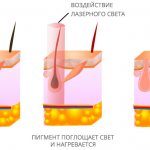 Суть лазерной эпиляции