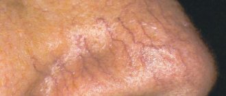 This is what skin with rosacea looks like