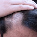 Телогеновая диффузная алопеция