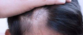 Telogen effluvium alopecia