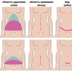 типы пластики живота