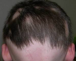 Трихофития волосистой части головы