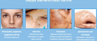 Убрать пигментацию на лице в домашних условиях быстро. Кремы, народные средства