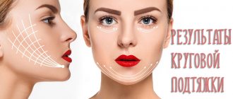 Successful and unsuccessful photos of a circular facelift before and after surgery