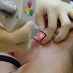 Удаление лазером новообразований на коже, наростов, папиллом. Как проходит процедура, цена, отзывы