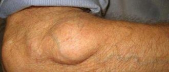 удаление липомы отзывы