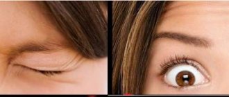 Removing bags under the eyes