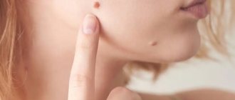 Laser removal of papillomas