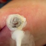 Liquid nitrogen removal