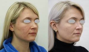 уменьшить кончик носа, фото до и после, Анвар Салиджанов
