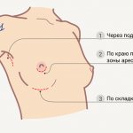 увеличение груди разрезы