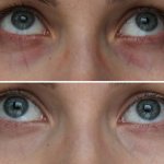 Wreaths around the eyes